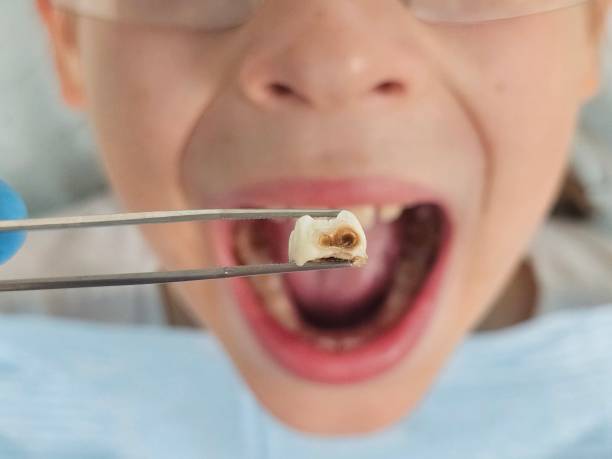 Best Chipped Tooth Repair Near Me  in Roman Forest, TX